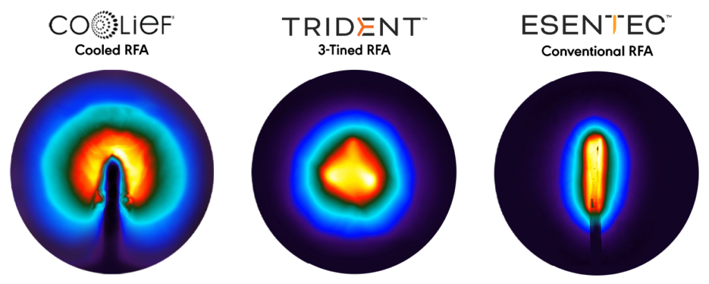 Lesion comparison of COOLIEF*, TRIDENT* and ESENTEC*